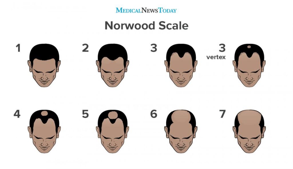 Male Pattern Baldness