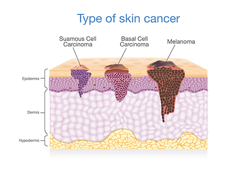 Skin Cancer
