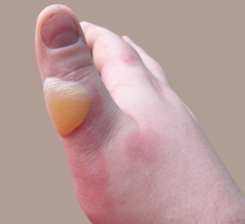 Hot Water blister
