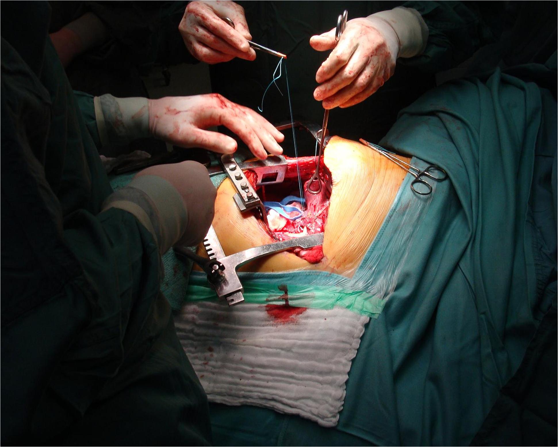 Lung Surgery