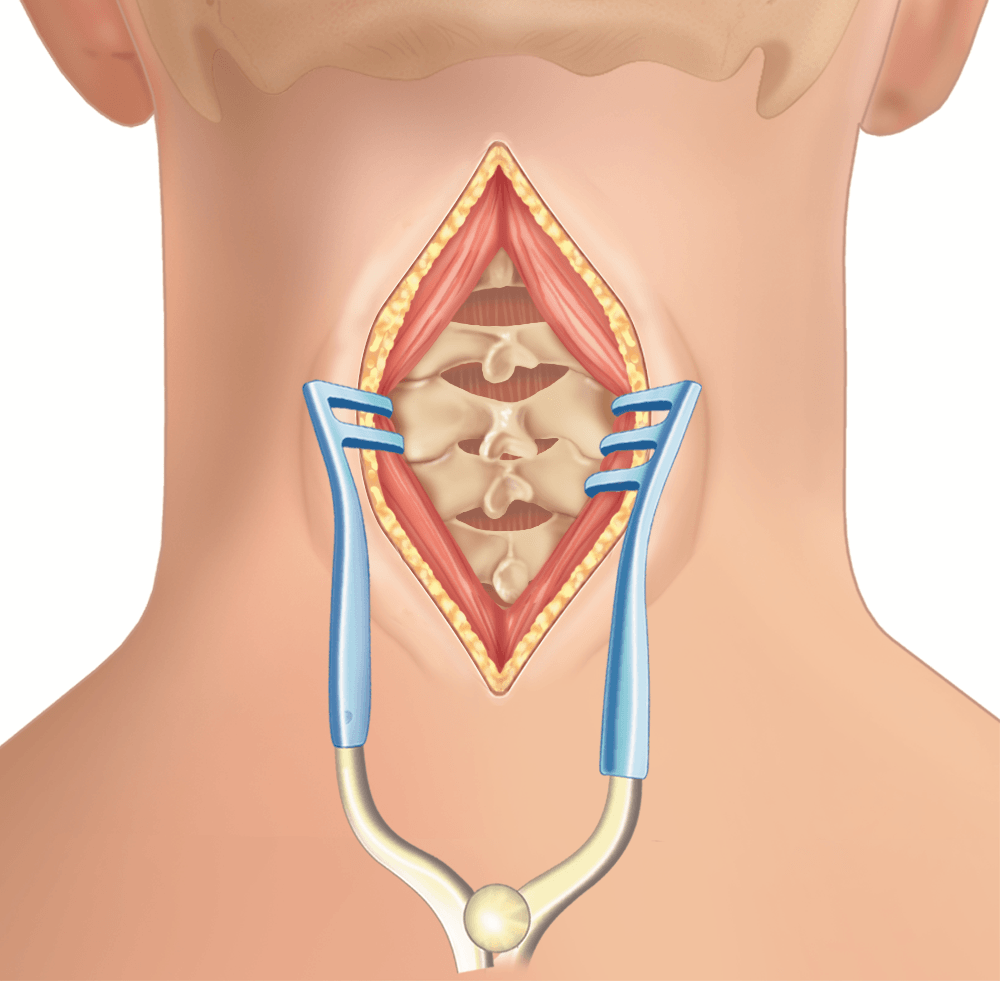 Neck Surgery