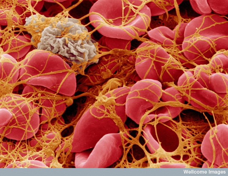 Blood clot