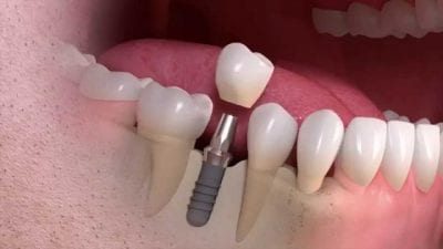 Dental implant surgery