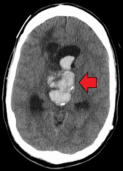 Brain